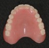 Figure 1  Lingualized posterior occlusion: maxillary complete denture with anatomical teeth (Vitapan® Cuspiform 23° to 28°).