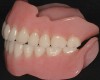 Figure 3  Lingualized posterior occlusion: maxillary complete denture and mandibular implant stress-broken overdenture.