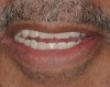 Figure 4  Lingualized posterior occlusion: Vitapan<sup>®</sup> anterior and posterior teeth.