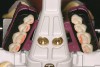 Figure 5  Filou 28 Denture set-up system: maxillary teeth-jig assembly. Mondial<sup>®</sup> teeth.