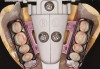 Figure 6  Filou 28 Denture set-up system: mandibular teeth-jig assembly. Mondial<sup>®</sup> teeth.