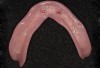 Figure 10  Mandibular metal-reinforced overdenture with ball-abutment retentive elements picked up intraorally.