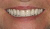 Figure 11  Completed maxillary complete denture and mandibular overdenture.