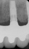 Figure 14  Radiographs of edentulous maxilla: dental implant fixed partial denture.