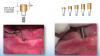 Figure 1. Determining tissue height.