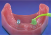 Figure 5. Light body impression material is injected around the coping.