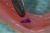 Figure 23. After placing pressure on the indicating paste on the tops of the denture caps, areas for denture caps are relieved. 
Photos courtesy of John Bain DDS