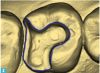 Fig 2. Using CAD CAM software to prepare a margin.