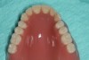 Figure 17 Occlusal view of the final denture.