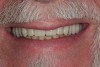 Figure 20 The patient was delighted with both the fit and the appearance of the final denture.